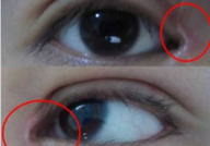 眼睛凹陷怎么办,重拾明亮双眸